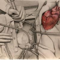 Drawing of a heart transplant operation