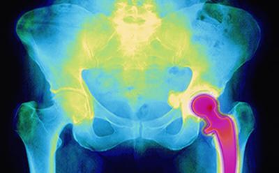 Bone scans to be taken of 100,000 middle-aged people