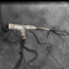Coronary artery image fusion