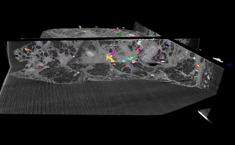 Multiple areas of active fibrosis identified by µ-CT