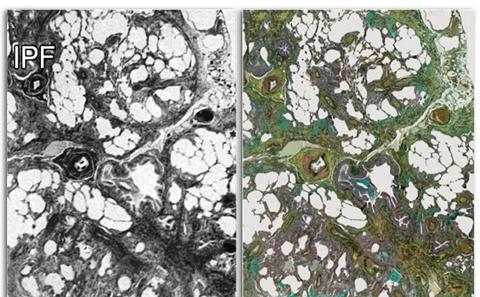 Microfocus CT scan of IPF lung tissue