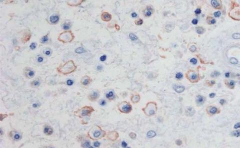 GMA section of nasal polyp stained by immunohistochemistry for CD4+ lymphocytes