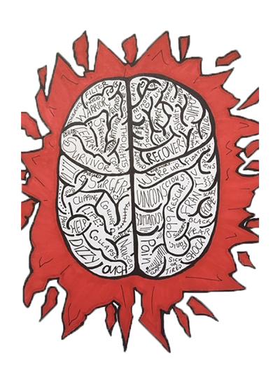 Subarachnoid haemorrhage