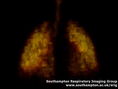 3D SPECT image showing the distribution of a radioactive gas in the lung