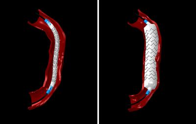 A balloon stent deployment within a patient specific right coronary artery