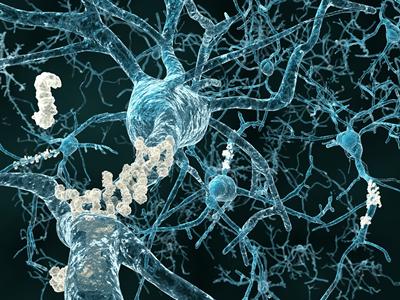 Alzheimer's disease 