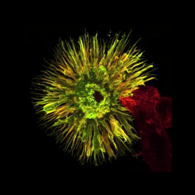 Globally, leukaemia accounts for some 300,000 new cases each year with 222,000 deaths