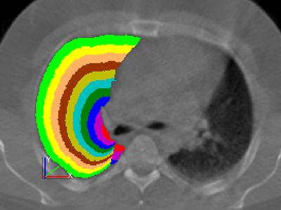 Example of the shell analysis process, showing the lung region divided into ten shells defined by the fractional distance from the hilum (chosen as the point where the main bronchous enters the lung).