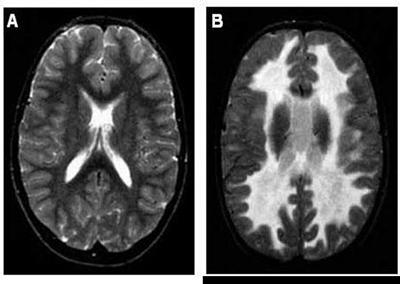 A - healthy brain; B - brain with Vanishing White Matter