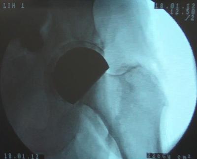 X-ray of the implant