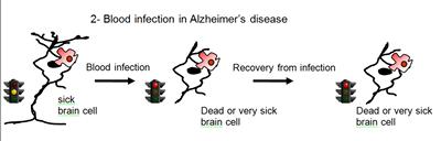 Blood infection in Alzheimer's...