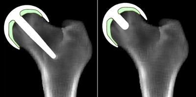 Virtual x-Rays showing Predictions of Bone Remodelling and Healing around Hip Resurfacing Implant Concepts