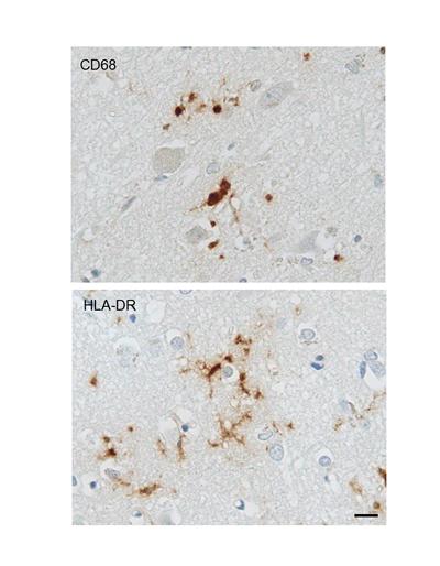 Illustration of microglial CD68 and HLA-DR immunostaining in Alzheimer’s disease