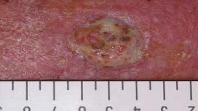 Chronic infected venous leg ulcer
