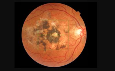 Genetic investigation of AMD