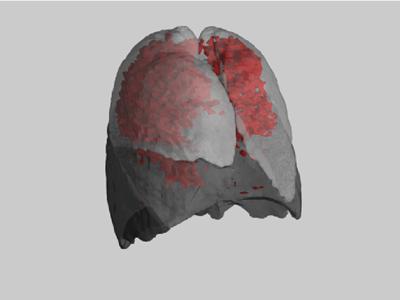 Example of the distrubution of emphysema throughout the lung, of a subject with moderate COPD