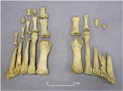 Lesions characteristic of leprosy in the feet of Co. Kildare skeleton