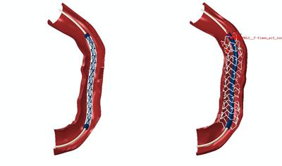 Simulation of stent deployment in a reconstructed coronary artery.