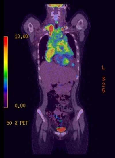 PET scan of someone with lymphoma