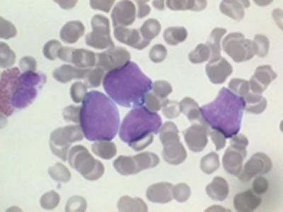 Southampton scientists hope to improve treatment of a rare form of non-Hodgkin Lymphoma
