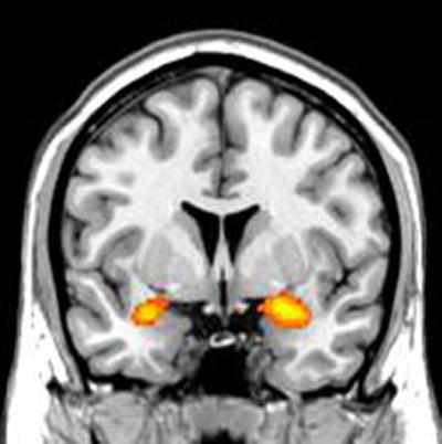 Brain scans of aggressive and antisocial teenage boys with conduct disorder (CD) have revealed differences in the structure of the developing brain that could link to their behaviour problems.