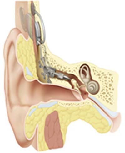 The implant is the UK’s first totally implantable hearing aid 