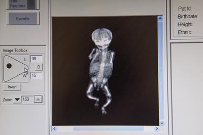 DXA scan