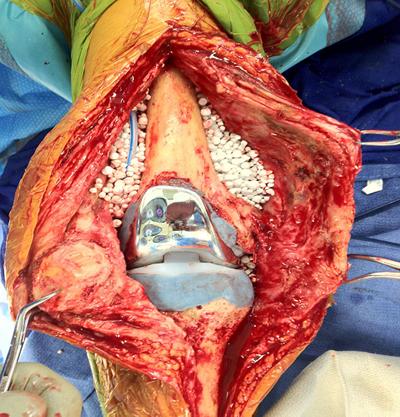 Prosthetic Joint with antibiotic loaded beads
