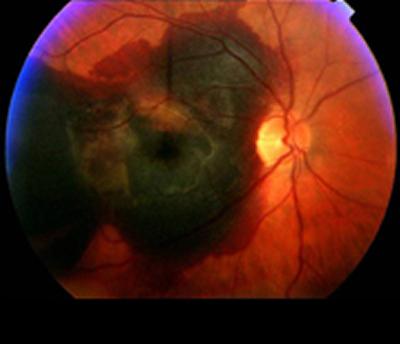 Seven genetic risk factors found to be associated with AMD