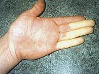 Vibration induced white finger (VWF)