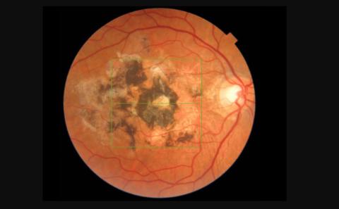 Eye diseases