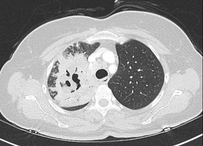 TB lung