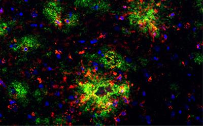 Amyloid and FcR