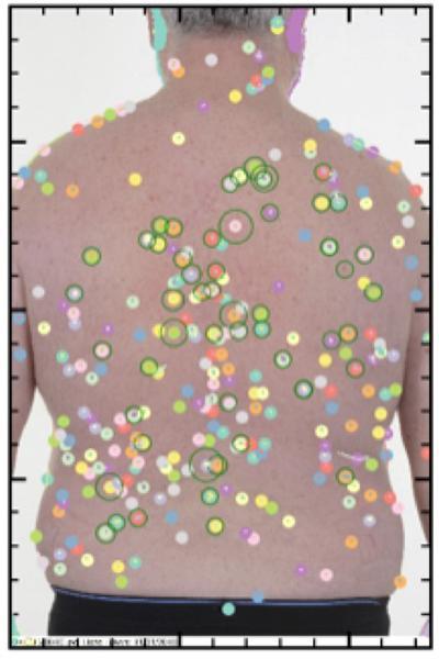 Skin cancer