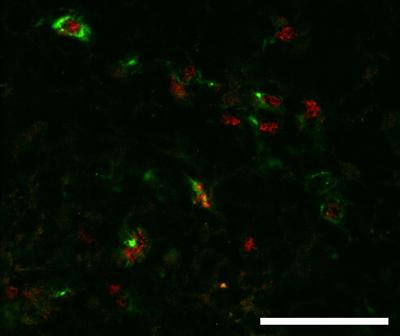 Intratumoral Treg cells