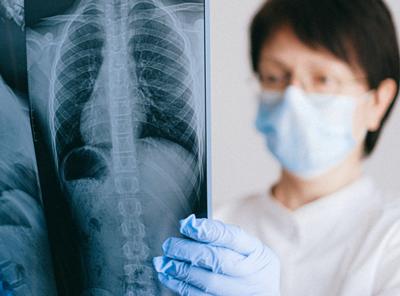 Lung xray