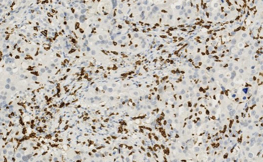 T-cells and cancer cells in tumour