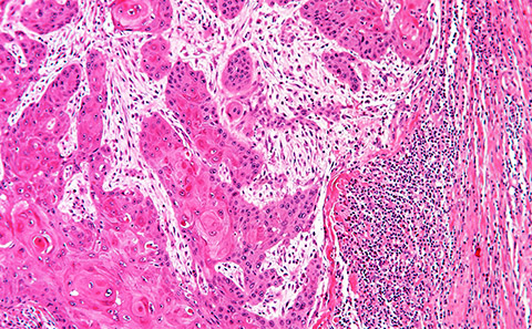 Microscope image of human cancer.