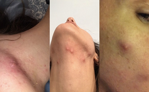 Acne on the neck, face and shoulder