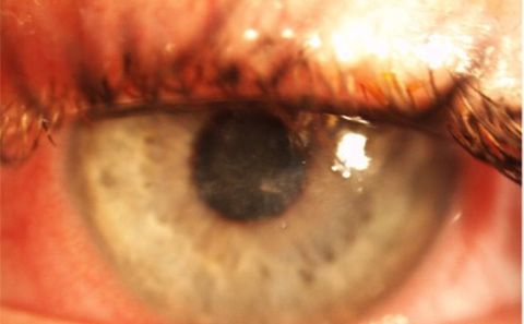 Eye with Acanthamoeba Keratitis