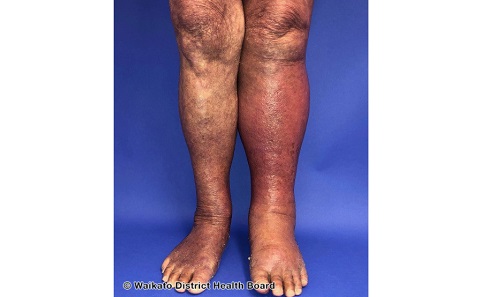 Lower leg cellulitis