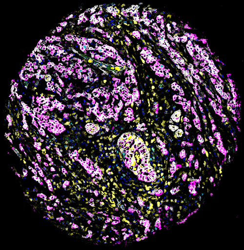 Microscope image of a breast cancer tissue sample. Different coloured stains highlight centrosomes (pink), epithelial cells (red, magenta, yellow and grey), blood vessels (green), dividing cells (cyan) and dying cells (turquoise). The blue stain shows the cell nuclei.