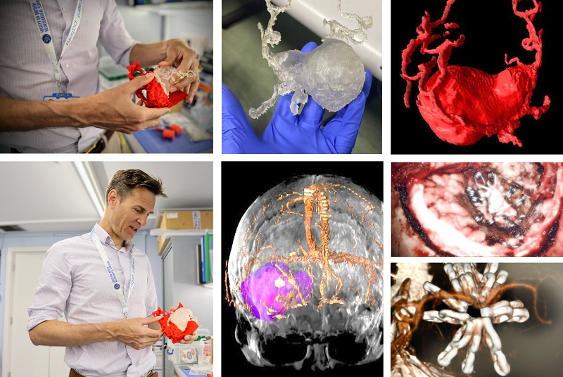 (top left, bottom left, top centre) Prof. Bulters examines the 3D-printed aneurysm and skull assembly; (top right): Digital 3D copy of the aneurysm; (bottom centre) Magnetic Resonance Angiography (MRA) 3D rendering highlighting the aneurysm (in purple) prior to surgery; (centre right, bottom left) Intraoperative image showing the aneurysm patch repair & Postoperative CT image confirming the repair)