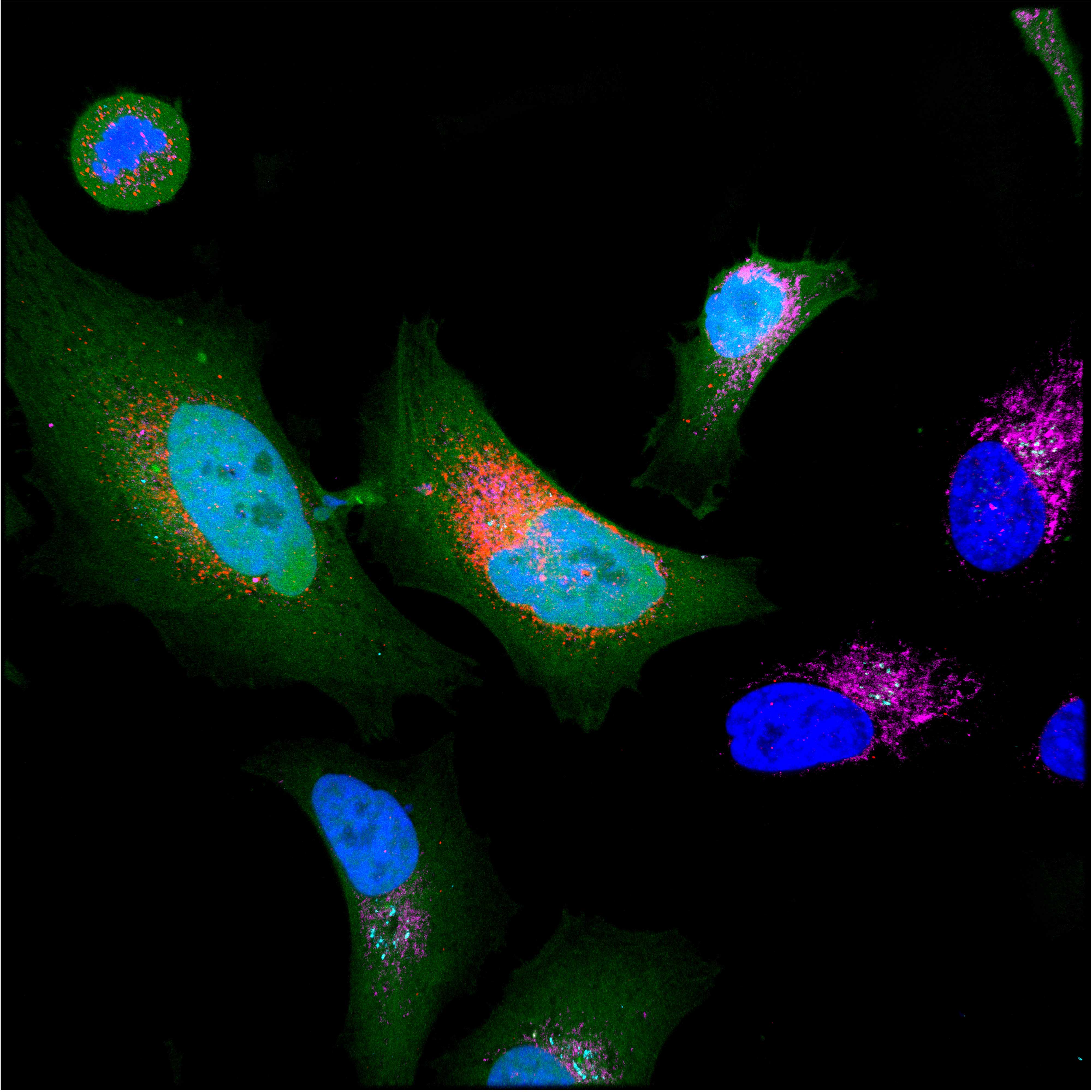 Cancer cell expressing microprotein (coloured in red). 