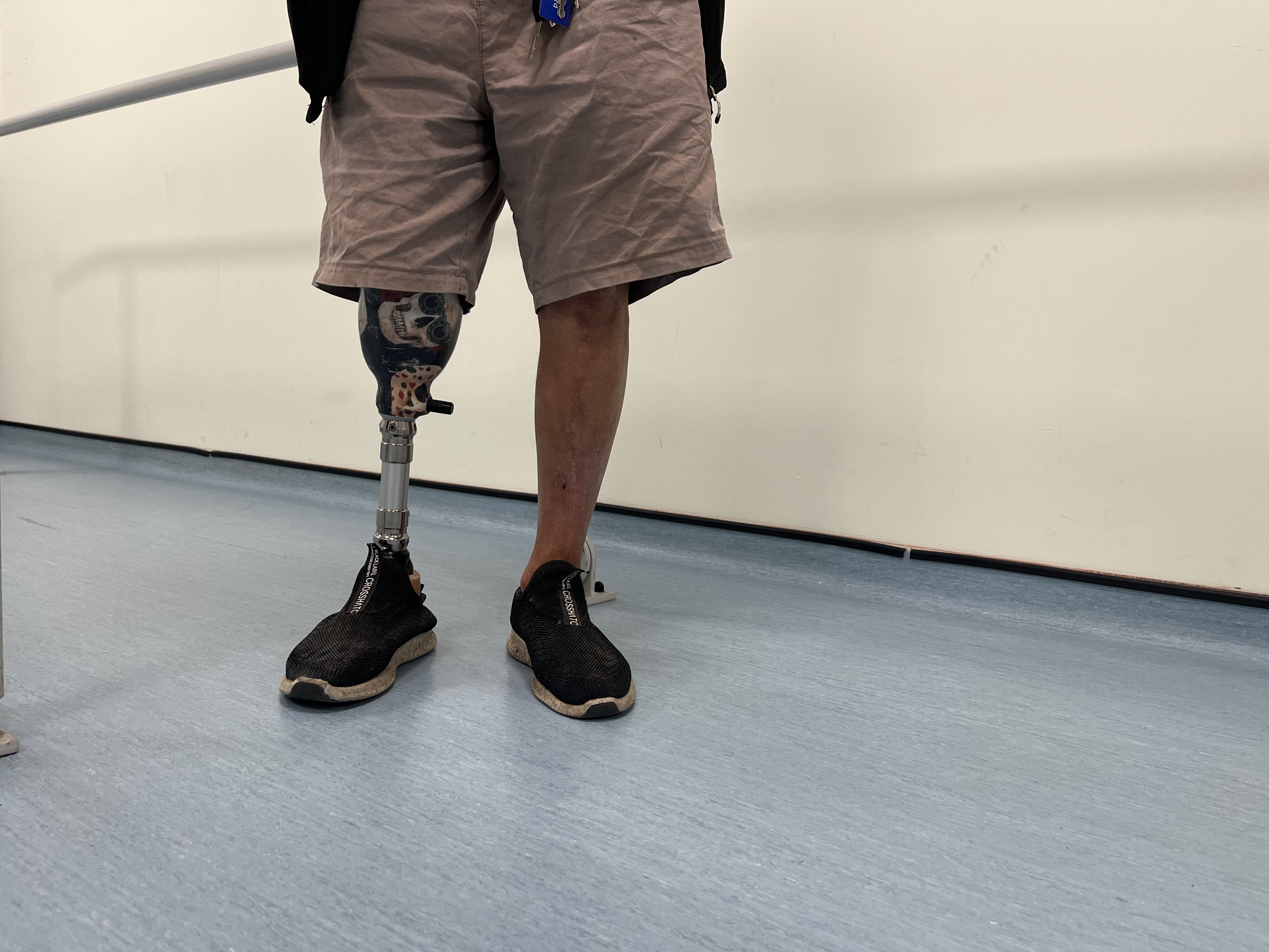 A person wearing shorts stands indoors on a light blue floor. One of their legs is a prosthetic limb with a decorative socket featuring a skull design. Both feet are wearing black trainers.