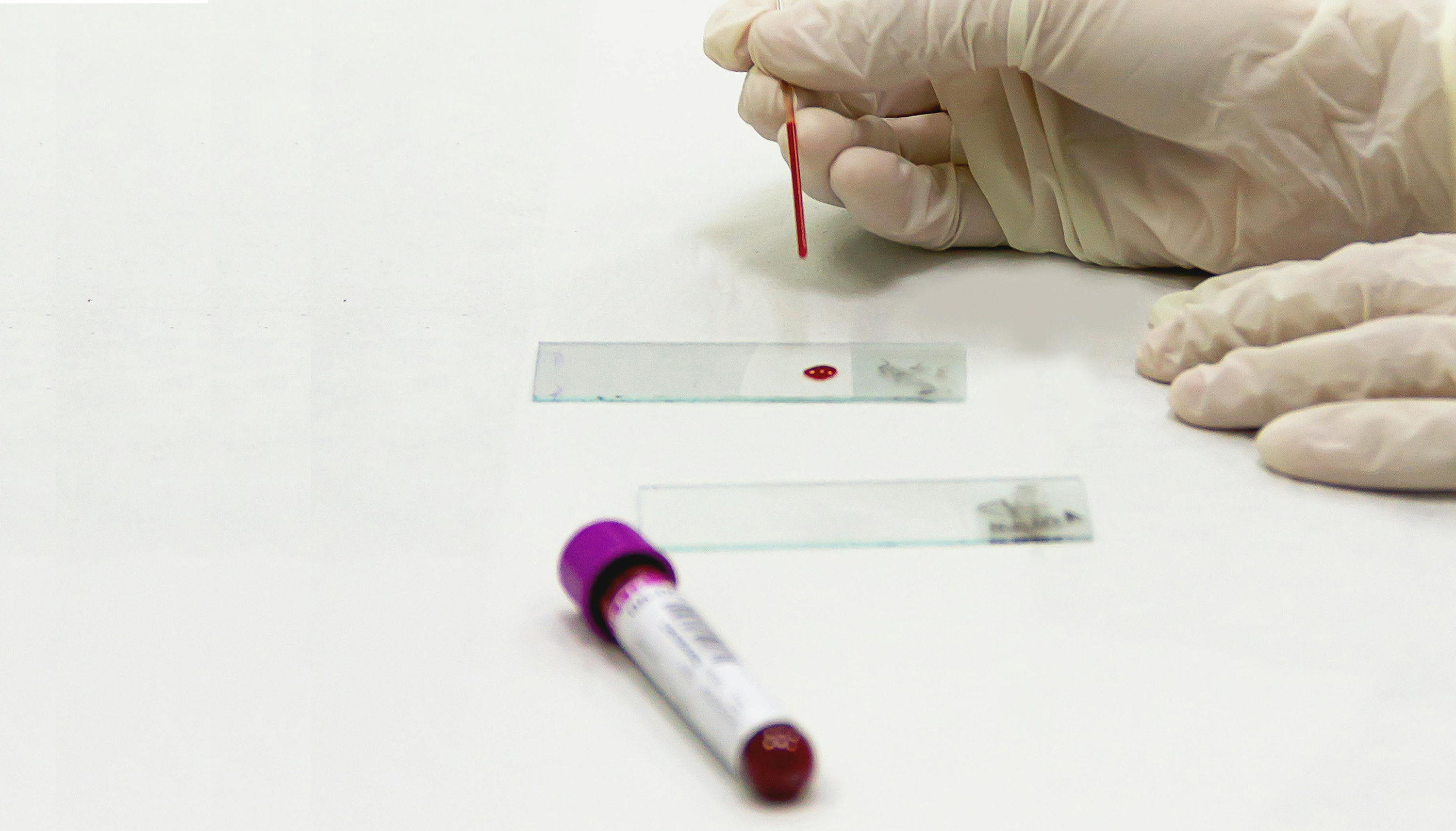 A gloved hand placing a small drop of blood onto a glass microscope slide using a capillary tube. A blood sample vial with a purple cap is also visible in the foreground, slightly out of focus.