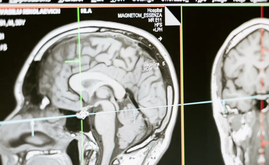 MRI scan of a human head showing the brain in profile