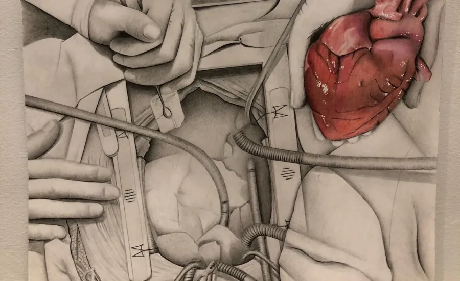 Drawing of a heart transplant operation
