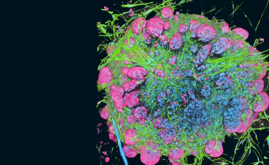 Oesophageal cancer associated fibroblasts