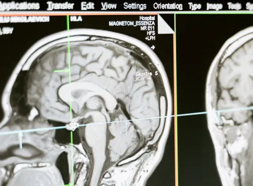 MRI scan of a human head showing the brain in profile